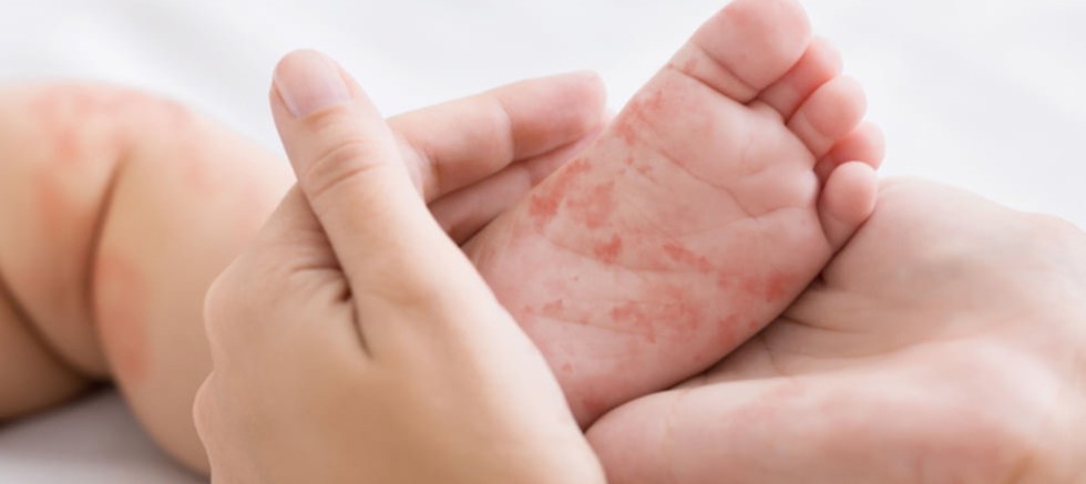 Ailedeki alerjik reaksiyonlar çocuklara miras olabilir…