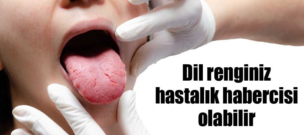 Dil renginiz hastalık habercisi olabilir