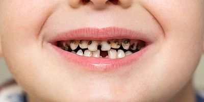 875 Bin Çocuğun Kalıcı Dişlerinde Çürük Tehlikesi Var