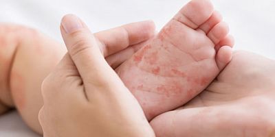 Ailedeki alerjik reaksiyonlar çocuklara miras olabilir…