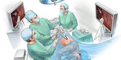 Akciğer kanseri cerrahisinde tek ve küçük kesiden ameliyat yapılıyor!