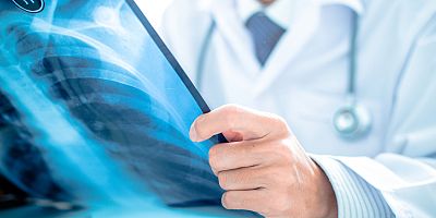 Akciğer kanserinde bu ilk belirtilere dikkat!