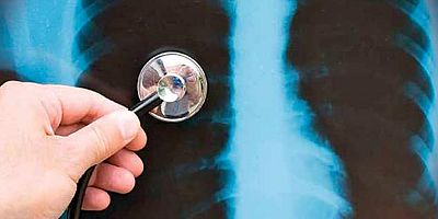 ‘Akciğer yüksek tansiyonu’ hayatı tehdit eden bir hastalıktır