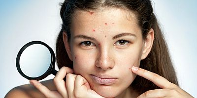 Akne tedavisinde yapılan 10 önemli hata