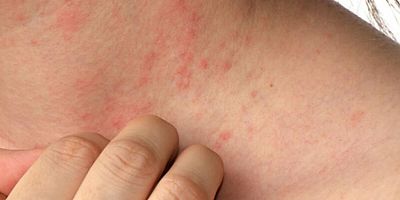 Akşam saatlerinde yoğunlaşan kaşıntıya dikkat!