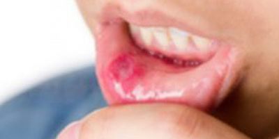 Alkol tüketiminde aşırılık ağız kanserine neden oluyor