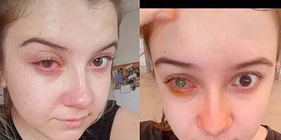 Bilinçsiz kontakt lens kullanımı göz kaybına neden olabilir