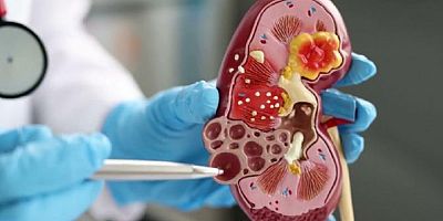 Böbrek kanseri sinsice ilerliyor