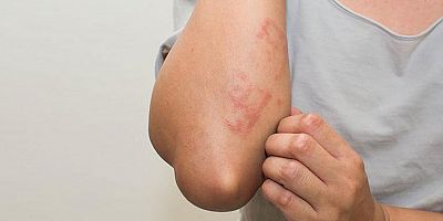 Cildinizdeki kabuklanma ve kızarıklığın nedeni seboreik dermatite olabilir