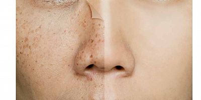 Cilt Lekelerinizden Korkmayın! Çaresi Var!