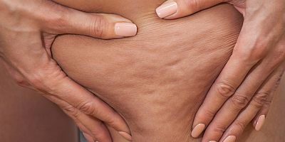 Dar giysiler selülit sorununu artırıyor