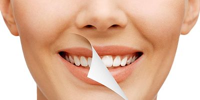 Diş beyazlatma ve bakımı