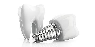 Diş İmplantları Hakkında 5 Efsane