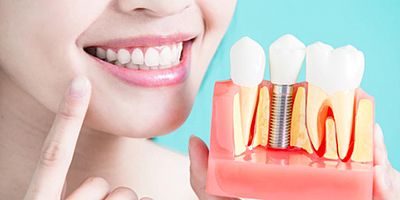 Diş İmplantları Hakkında Bilmeniz Gereken 9 Bilgi