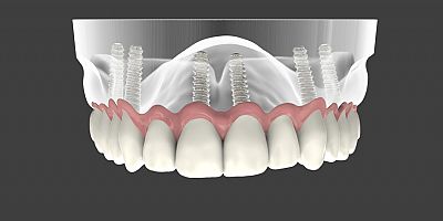 Diş İmplantları ile Eksik Dişleri Geri Kazanın