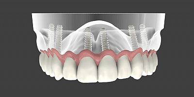 Diş implantları sizin için uygun mu?