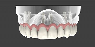 Diş İmplantlarının Ömrü Ne Kadardır?