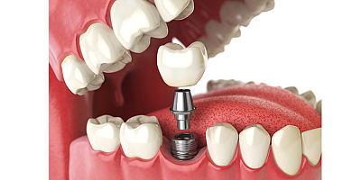 Diş tedavisi korkusu kansere davetiye çıkarıyor
