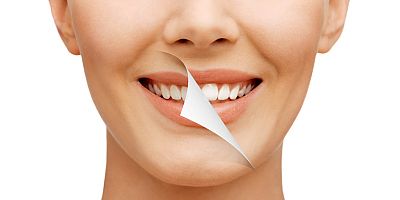 Dişlerinizi Ne Sıklıkla Beyazlatmalısınız?