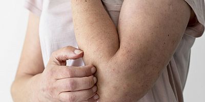 Egzama Tedavisinde Yeni Yöntem!