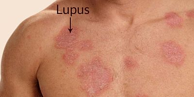 Eklem Ağrılarına Dikkat! Lupus Olabilirsiniz