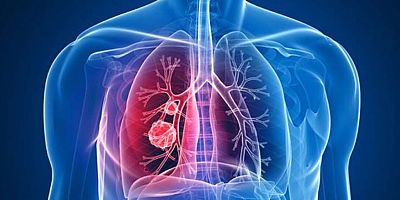 En Sık Rastlanan Akciğer Hastalığı: KOAH