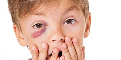 Ev kazaları çocukları kör bırakıyor, dikkat!