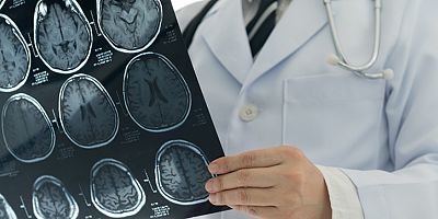 Fizik Tedaviye Erken Başlanılmazsa Felcin Kalıcılık İhtimali Artıyor