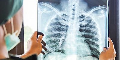 Gizli Akciğer Kanseri Vakaları Koronavirüs Nedeniyle Çekilen Tomografilerde Ortaya Çıkıyor
