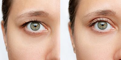 Göz kapağı düşüklüğü ciddi hastalıkların belirtisi olabilir