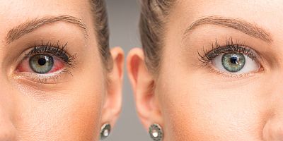 Göz kuruluğuna karşı 6 etkili kural!