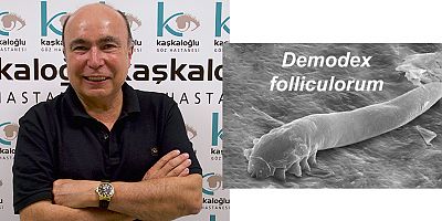Gözde Yanma, Sulanma ve Kaşıntı Varsa Demodex Parazitine Dikkat !