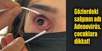 Gözlerdeki salgının adı Adenovirüs, çocuklara dikkat!