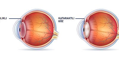 Gözlerdeki sis perdesi: Katarakt