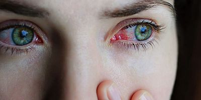 Gözlerdeki yeni salgının kaynağı: Adenovirüs