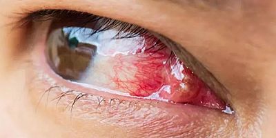 Gözün doğal görünümünü bozan hastalık: Pterjium