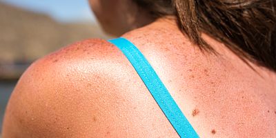 Güneş yanığına karşı 12 etkili öneri
