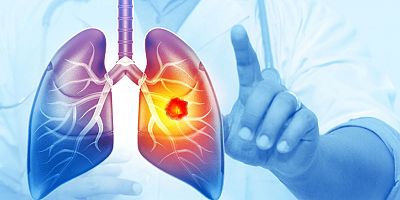 Her Yıl 25 Bin Akciğer Kanseri Vakası Önlenebilir 
