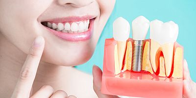 İmplant tedavisinde doğru tercih hekimlerden geçiyor