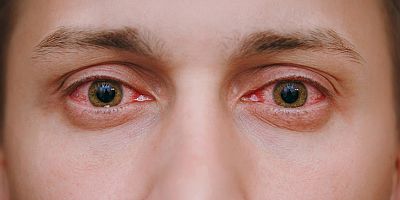 Kalıcı Hasar Bırakıyor: Kırmızı Göz Salgını!