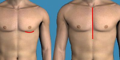 Kalp ameliyatları “Küçük Kesi Yöntemi” ile kâbus olmaktan çıkıyor 