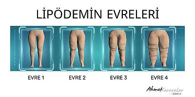 Kilo veremiyorsanız suçlu iradeniz değil, lipödem olabilir