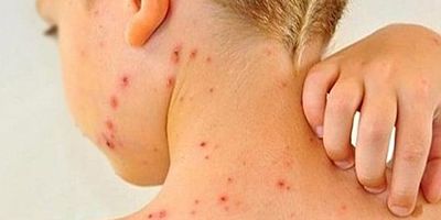 Kızamık Vakalarında Korkutan Artış