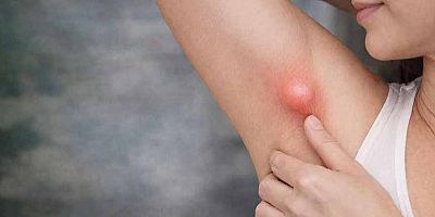 Koltuk Altındaki Şişlik Her Zaman Masum Değil: Ektopik Meme Dokusu Uyarısı