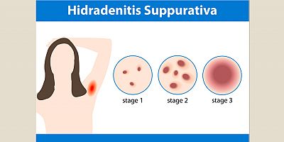 Köpek Memesi Hastalığının Tedavisinde Yüz Güldürücü Sonuçlar Var