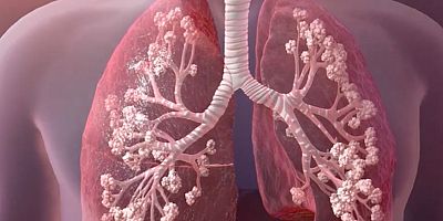 Koronavirüs sürecinde Kistik Fibrozis hastaları büyük risk altında! 