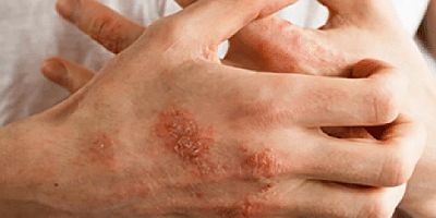 Koronavirüse karşı kullanılan el dezenfektanları el egzamasına neden olabilir