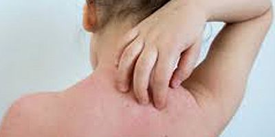 Kurdeşen Döküntüsü Olanlar Test Yaptırmalı