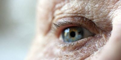 Kuru tip sarı nokta hastalığında sevindiren gelişme