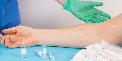 Maymun çiçeği döküntüsü